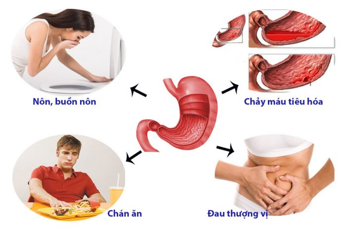 Đau dạ dày là gì Dấu hiệu, triệu chứng nhận biết bệnh đau dạ dày